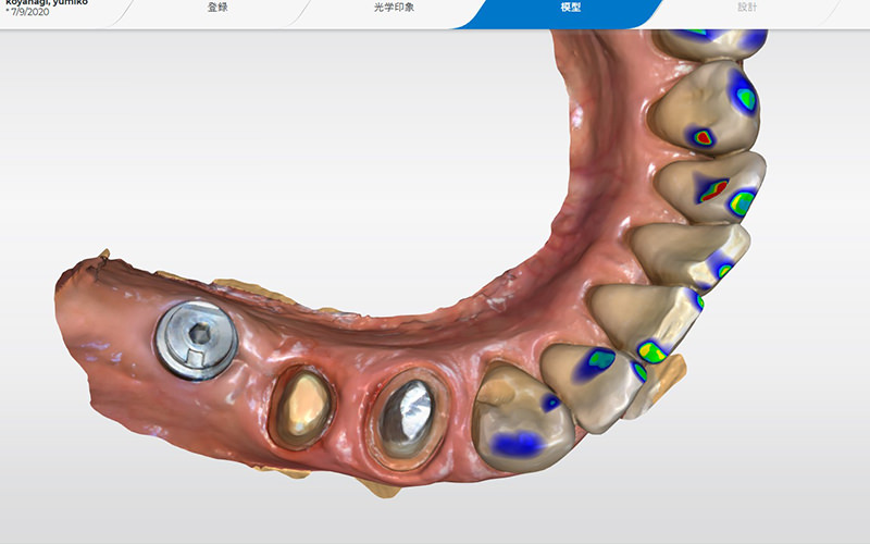 口腔内スキャナーによるインプラントの3D画像